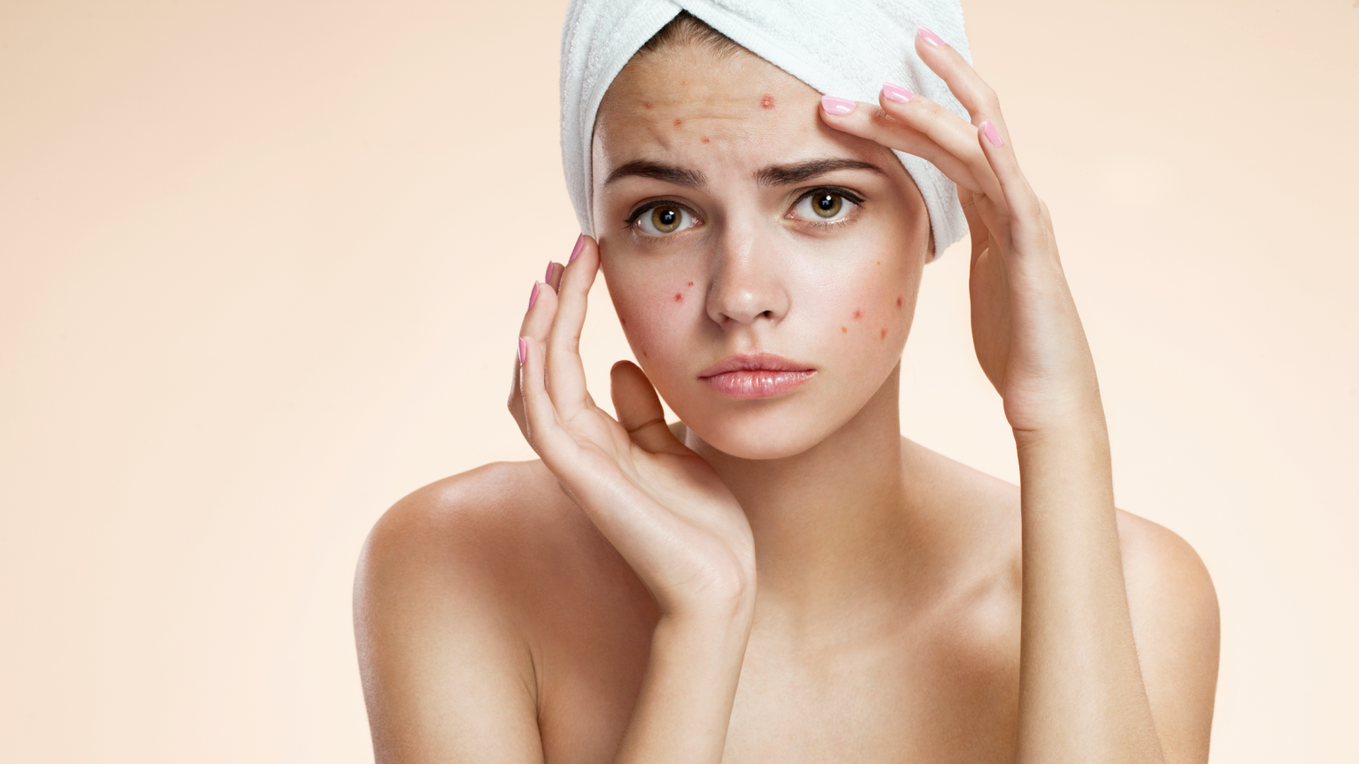 Acne e Espinhas: Estratégias Eficazes para uma Pele Limpa e Saudável